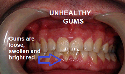 Unhealthy Gums