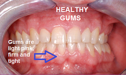 Healthy Gums