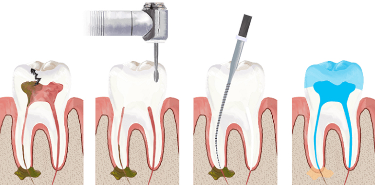 Teeth cleaning