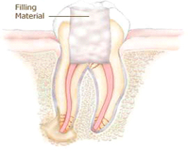 Filling Material