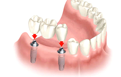 Tooth Caps