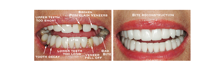 Bite Reconstruction