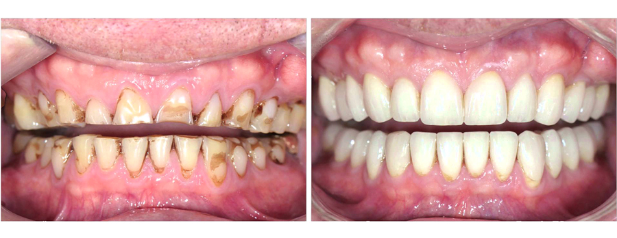Dirty and Clean Tooth Example