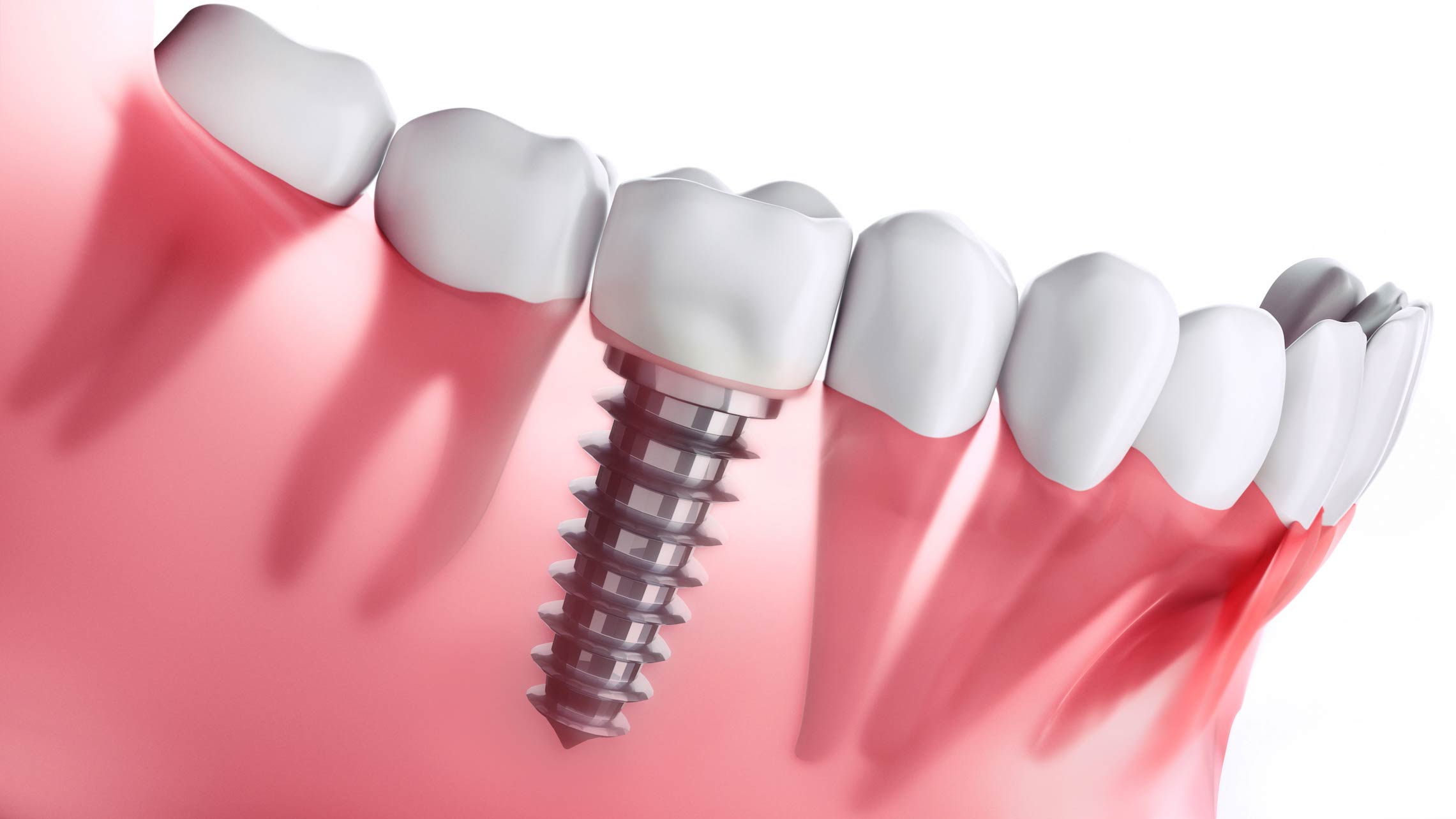 What To Expect During A Dental Implant Procedure And Its Advantages 3122