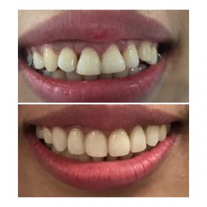 Gingival re-contouring